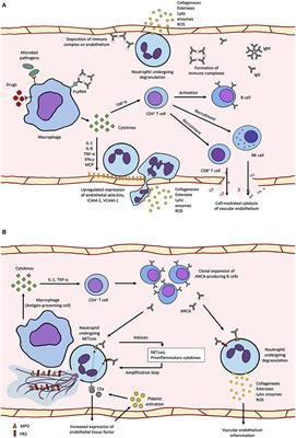 Unraveling the Immunopathogenesis and Genetic Variants in Vasculitis Toward Development of Personalized Medicine